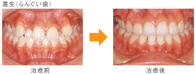 叢生（八重歯・乱ぐい歯）