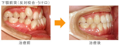 下顎前突（うけ口・反対咬合）